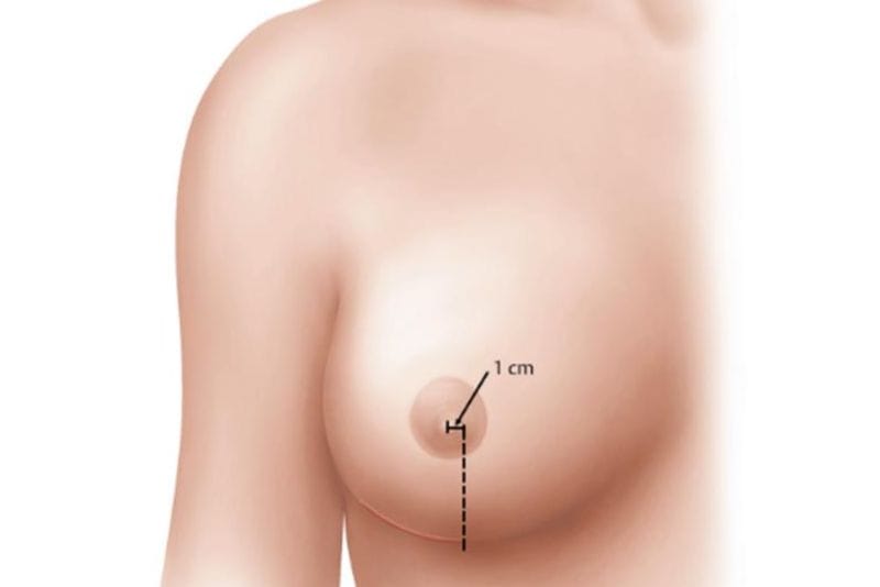 Đặt túi ngực qua đường quầng giấu sẹo tốt
