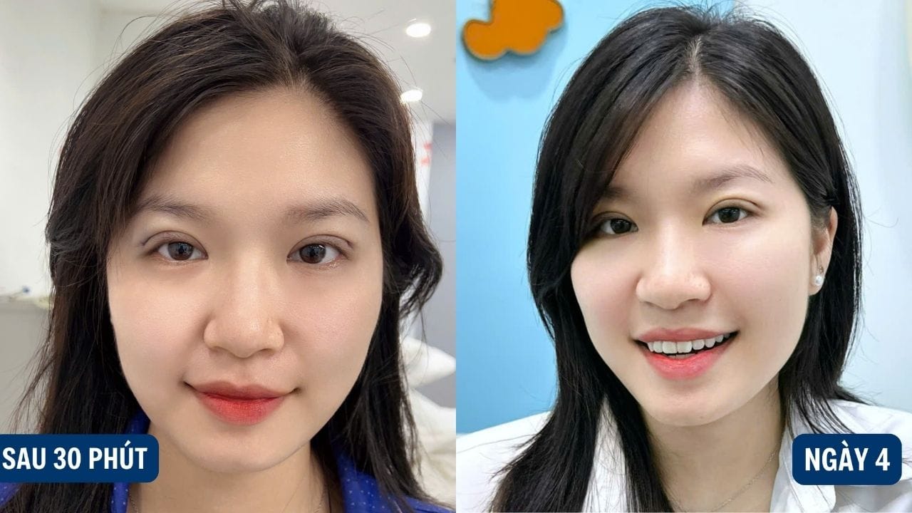 Nhấn mí bao lâu thì hồi phục? một số sai lầm khi chăm sóc