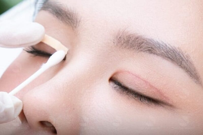 Chú ý chăm sóc vết thương sau cắt mí giúp mắt nhanh hồi phục