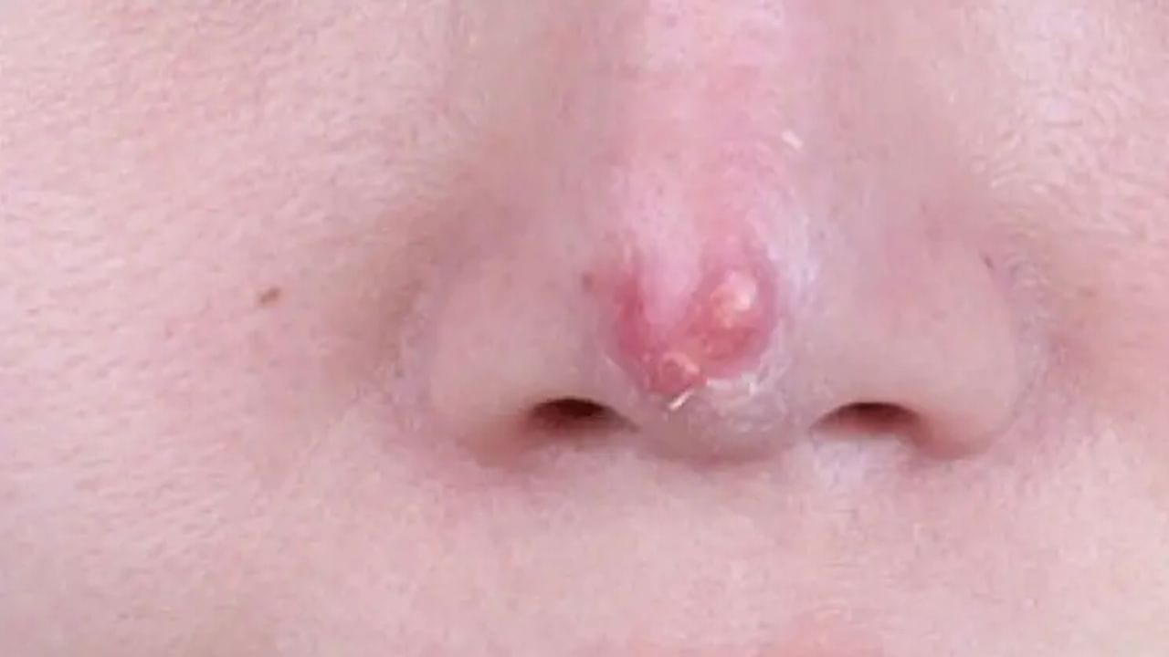 Sau nâng mũi bao lâu thì hết đỏ đầu mũi? 5 dấu hiệu đỏ đầu mũi bất thường