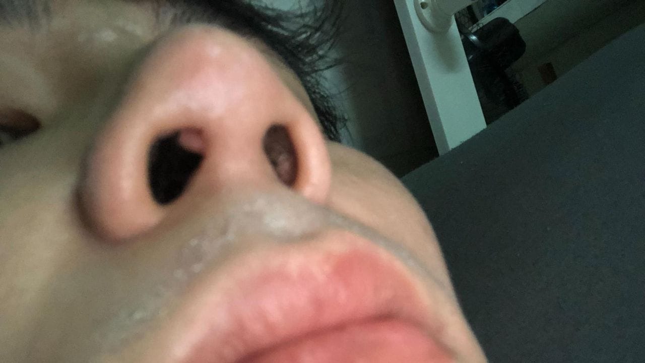 Sau nâng mũi bị nổi cục trong lỗ mũi là bị làm sao? Cách xử lý hiệu quả