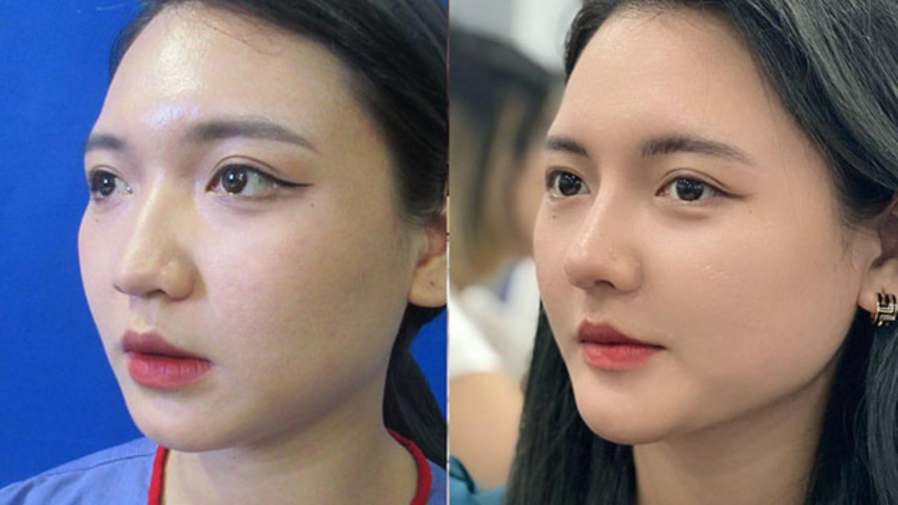 Sửa mũi có phá tướng không? Cách để có dáng mũi đẹp, hợp phong thủy