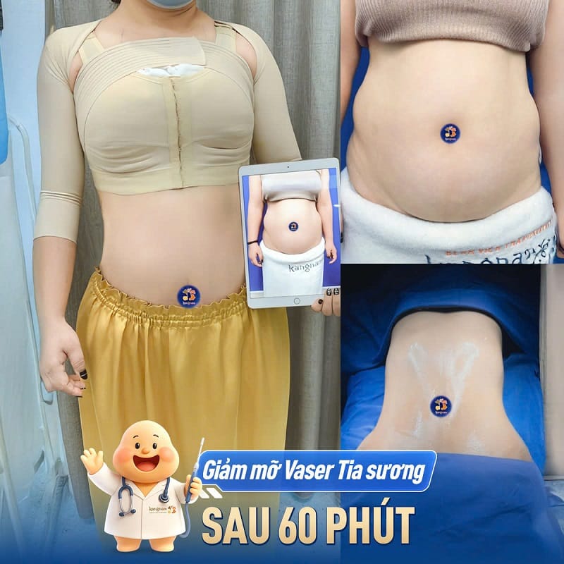 Khách hàng sở hữu vòng eo thon gọn, nhanh chóng