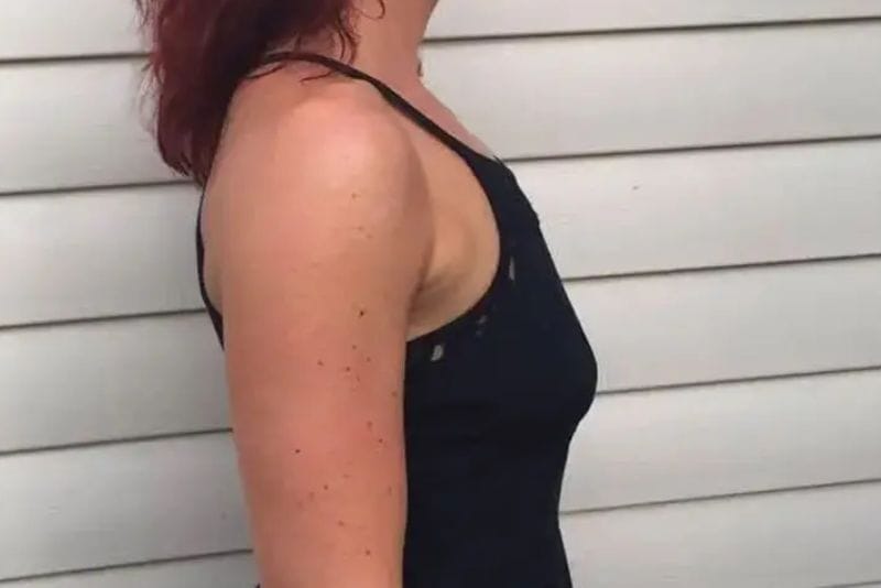 Ngực nhỏ, chảy xệ sau sinh