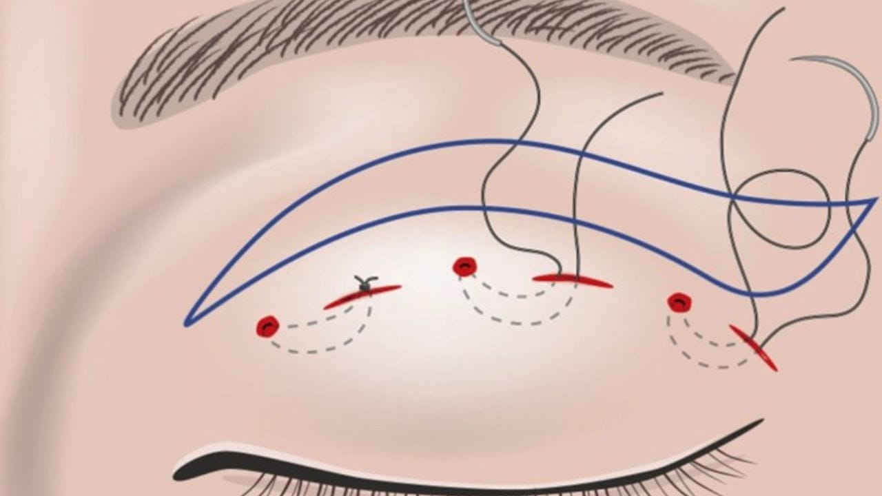 Tháo chỉ nhấn mí giá bao nhiêu? Bảng giá mới nhất