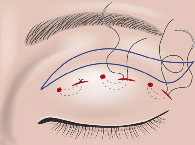 Chi phí tháo chỉ nhấn mí khá đa dạng
