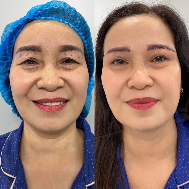 Treo cung chân mày có chi phí dựa vào nhiều yếu tố