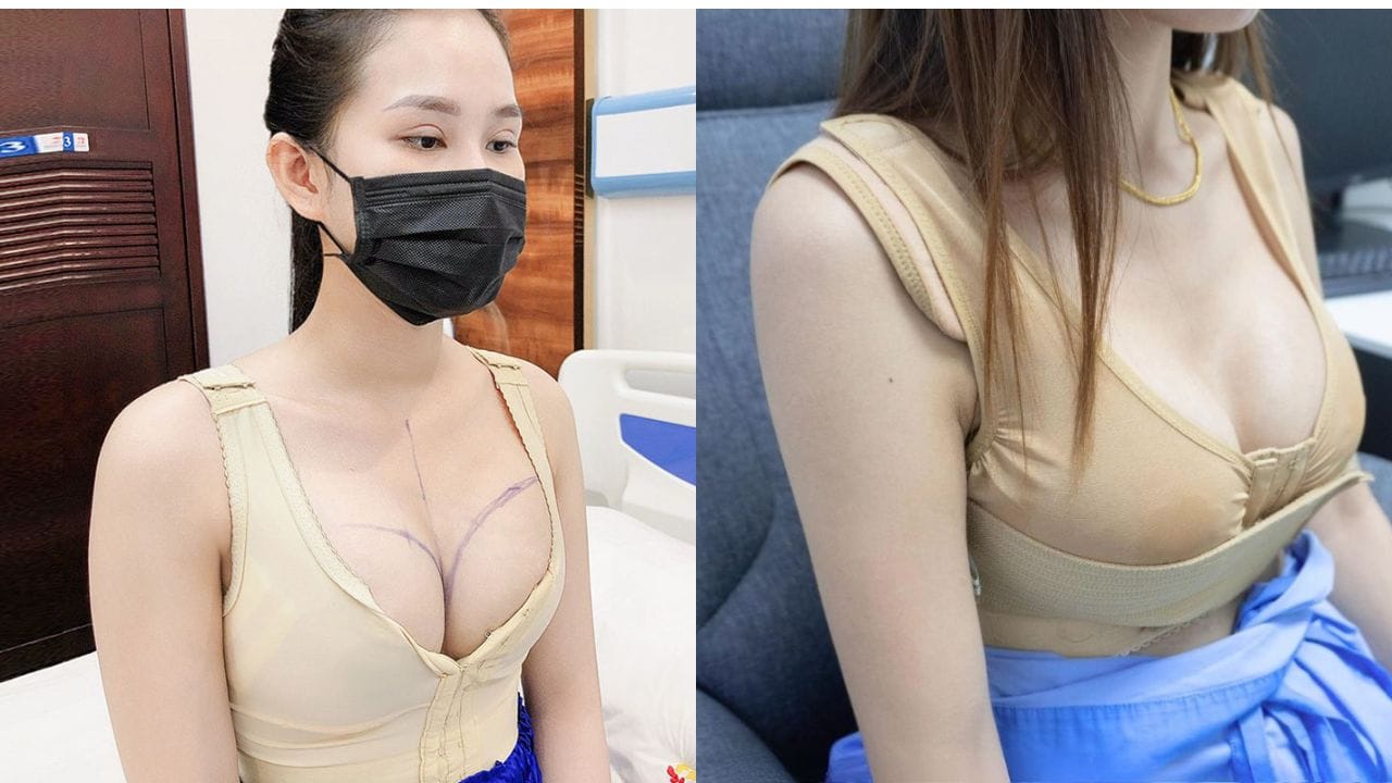 Treo ngực sa trễ mặc áo định hình bao lâu? Hướng dẫn mặc áo định hình đúng cách