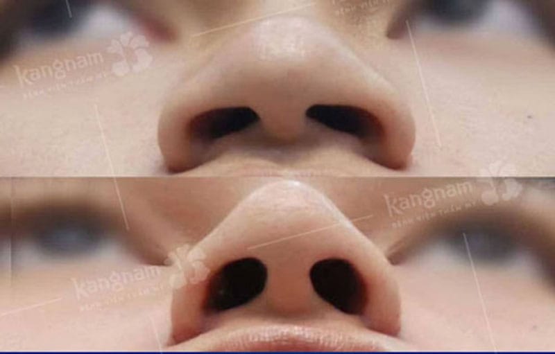 cánh mui to bè nên cân nhắc cắt cánh mũi