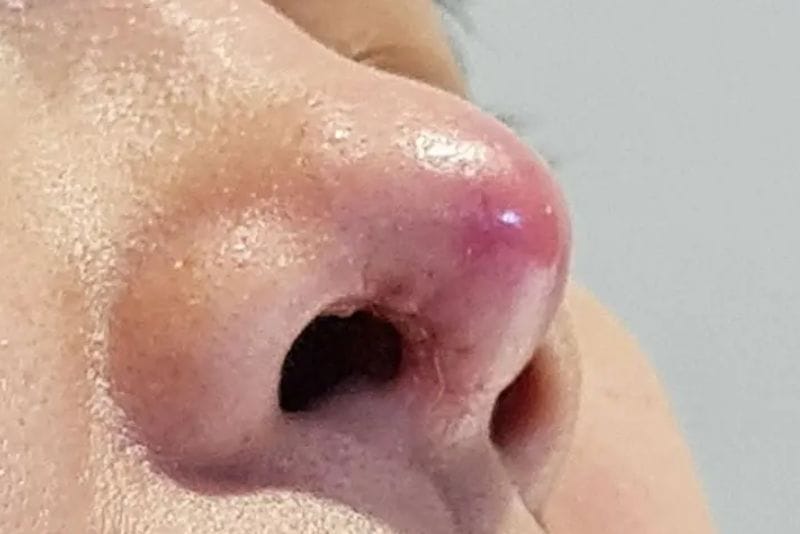 Mũi sưng lâu và chậm hồi phục