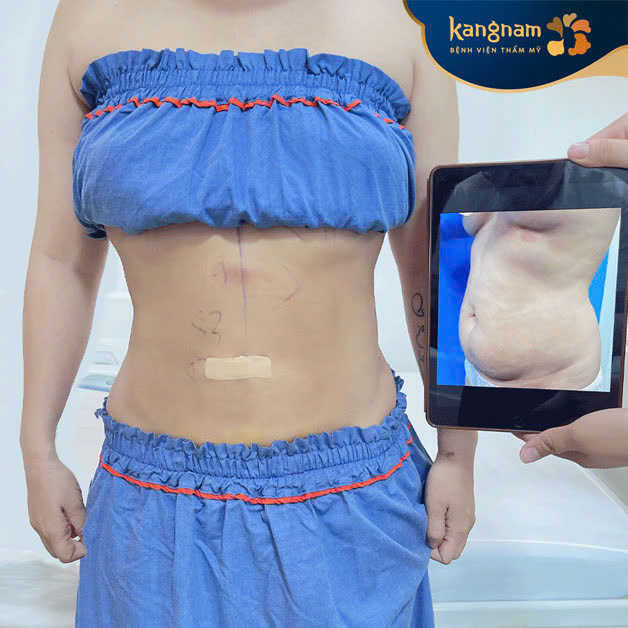 Individuals with localized abdominal fat that is difficult to reduce