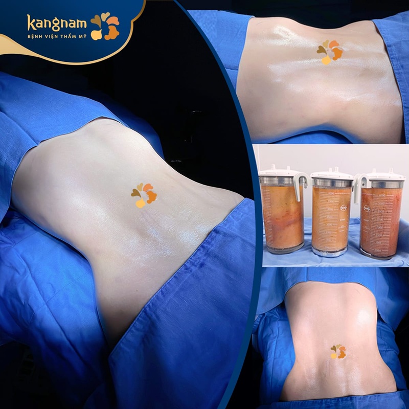 Abdominal liposuction ensures quick recovery and a natural, beautiful contour within 3–6 months
