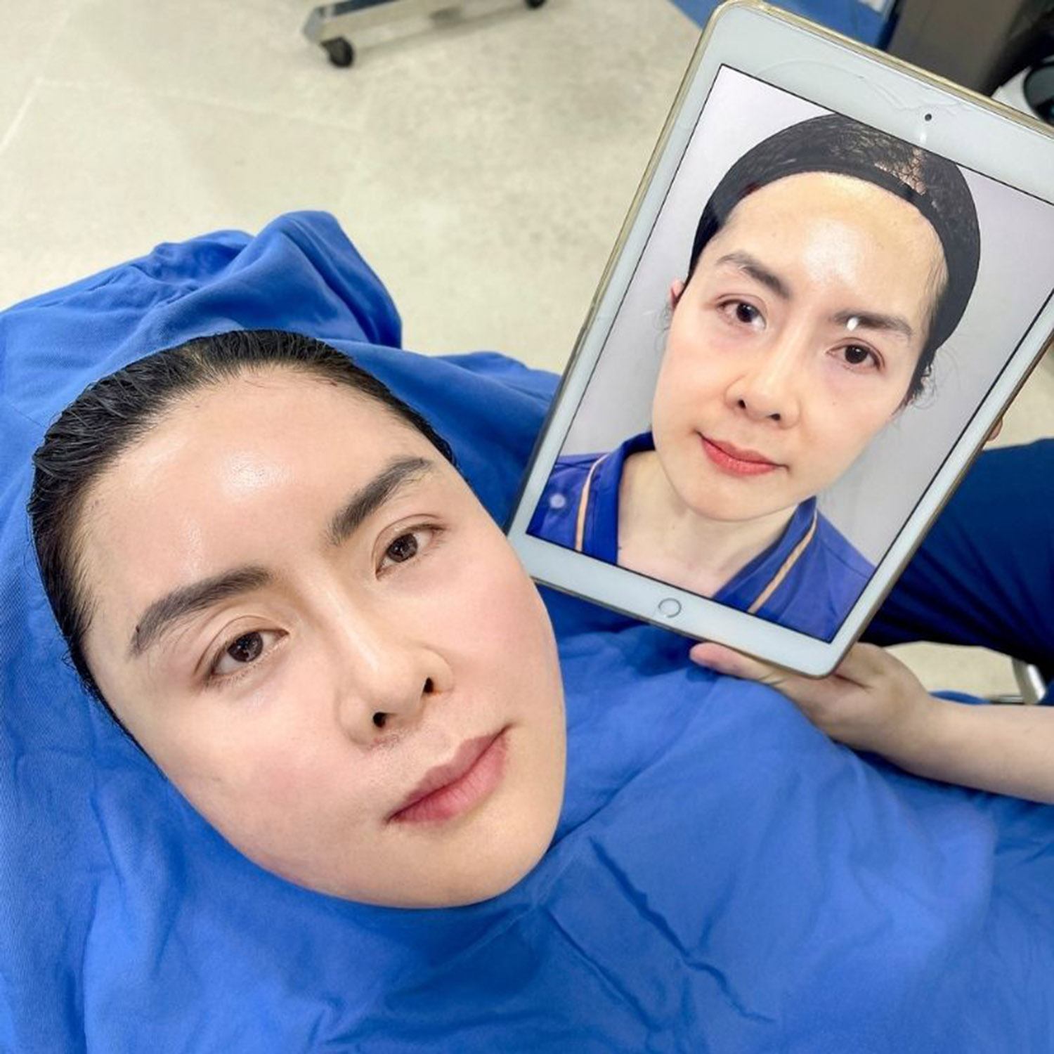 Autologous fat grafting restores a youthful, fuller appearance to the face.