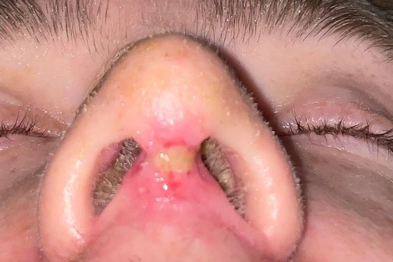 Abnormal signs requiring follow-up after rhinoplasty