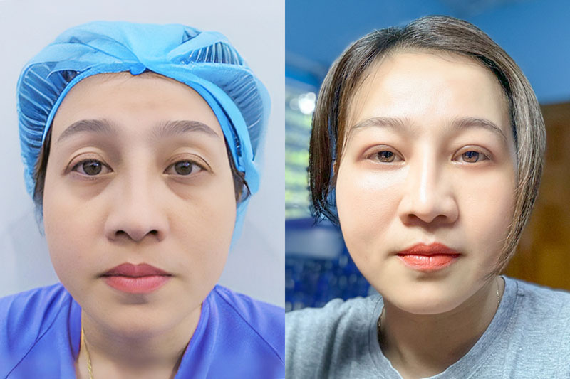 The face appears more youthful after eyelid surgery.