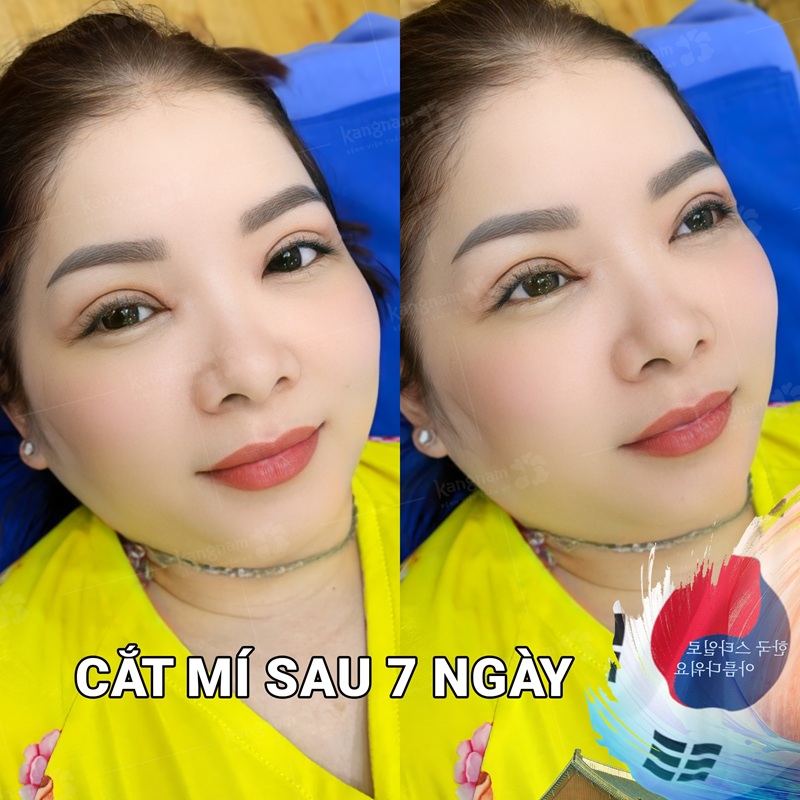Eyelid surgery for overseas Vietnamese clients – quick recovery