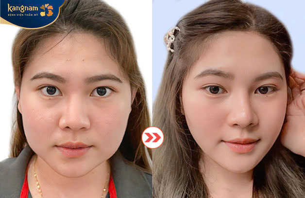 Jaw contouring helps improve chin shape and create a V-line face