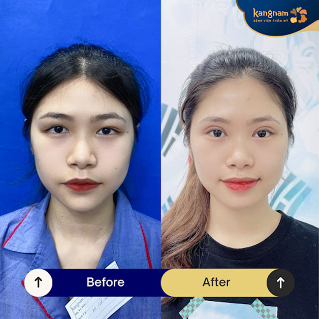 Eyelid surgery adds a refined focal point to the face, enhancing overall balance and expressiveness.