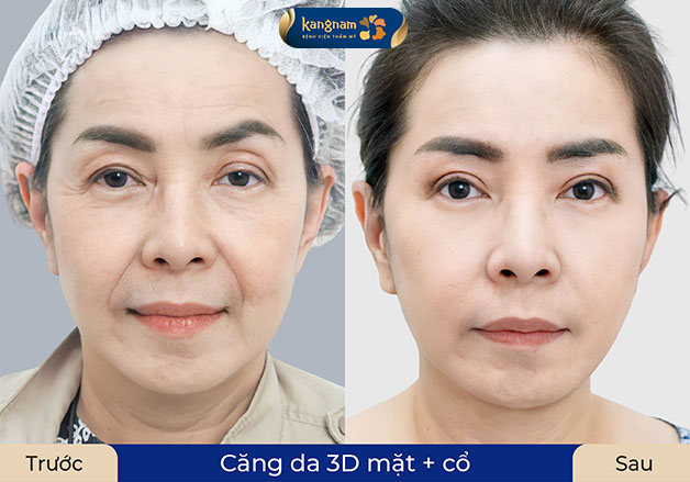 A facelift can help patients look up to 10 years younger.