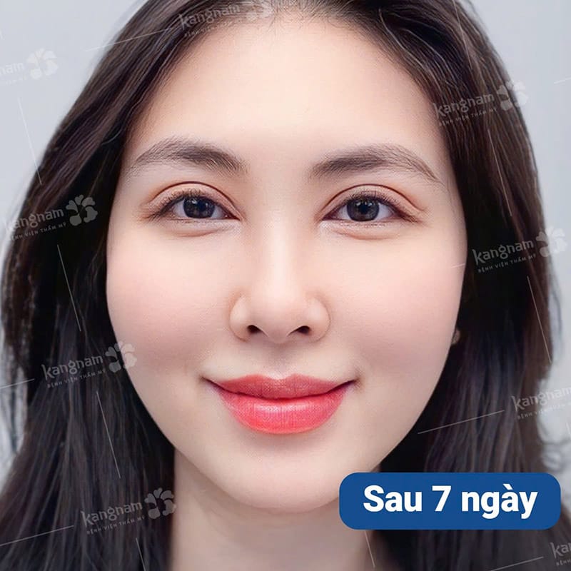 Tháo chỉ sau 7 ngày cắt mí