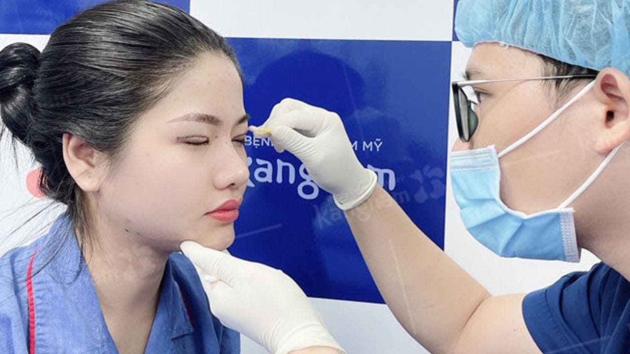 Cắt mí bao lâu tháo chỉ? Khách nước ngoài về Việt Nam cắt mí cần lưu ý điều này