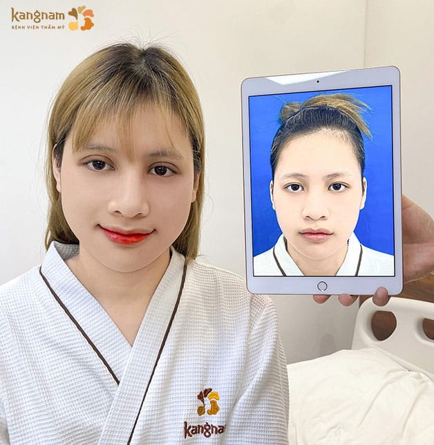 Tái khám đúng hẹn để kiểm tra nếp mí