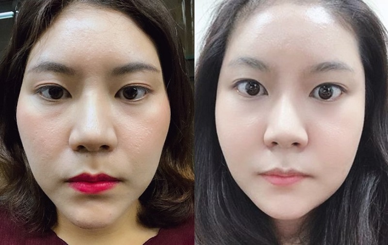 Lowering the cheekbones helps to create a more balanced and harmonious facial appearance.