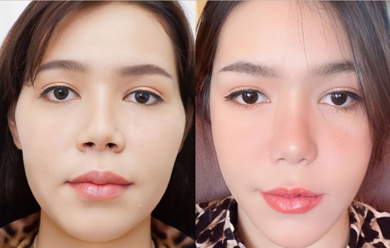 After a few days, the face will heal and stabilize.