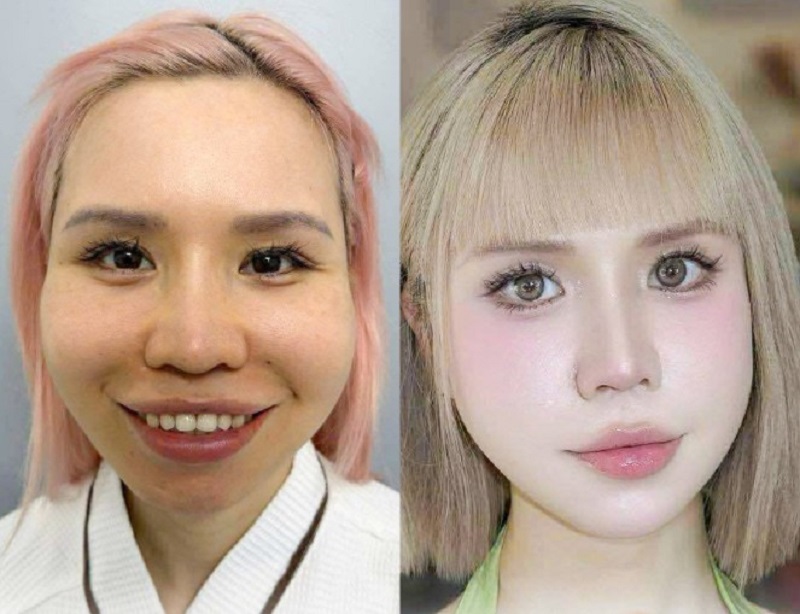 Natural and safe aesthetic results.