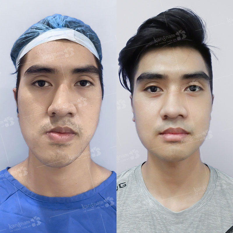 Correcting jaw asymmetry helps restore facial balance and harmony.