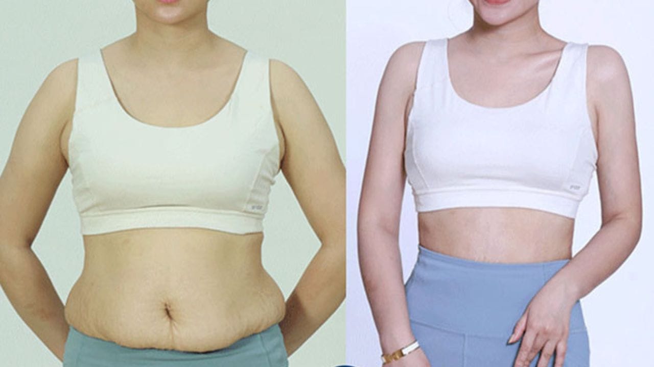 Hút mỡ có nguy hiểm không? Lý giải trường hợp gặp biến chứng khi hút mỡ