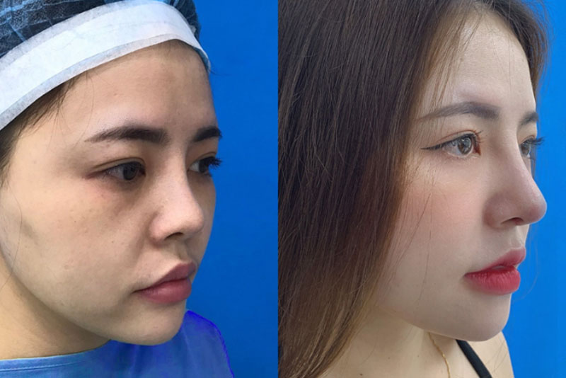 Results after 6D rhinoplasty