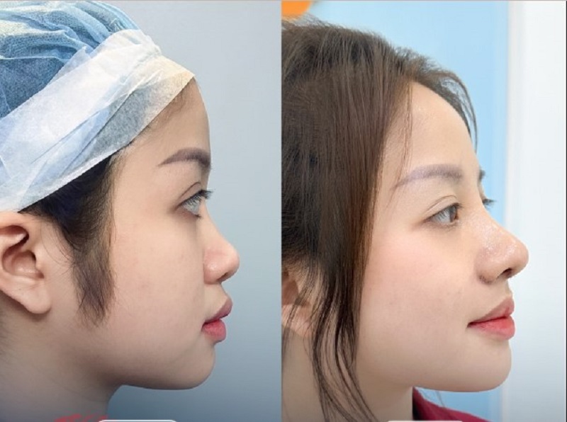 The nose shape is well-defined and looks natural.