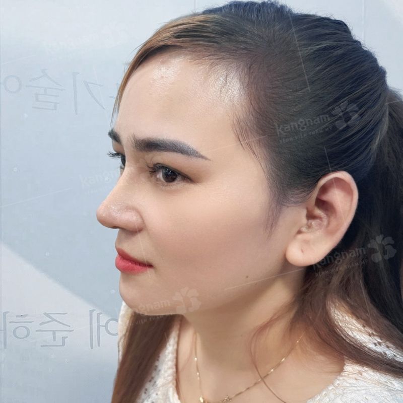 Rhinoplasty helps create a well-defined, elegant facial profile.