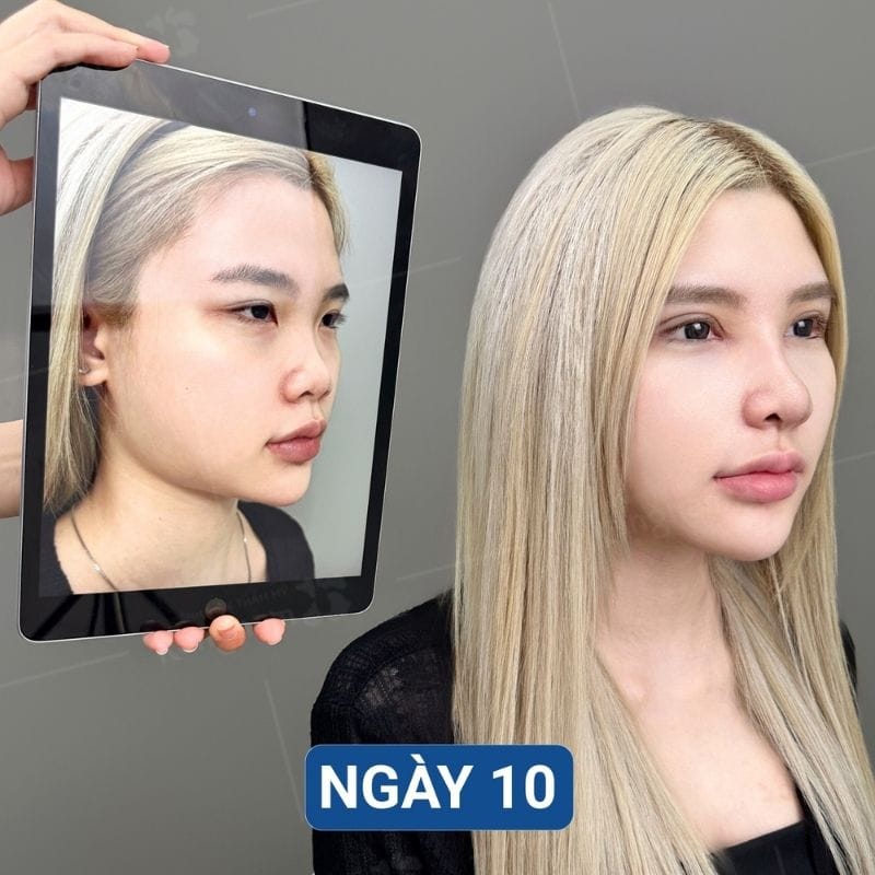 Khách Việt kiều sau nâng mũi hoàn toàn có thể đi máy bay