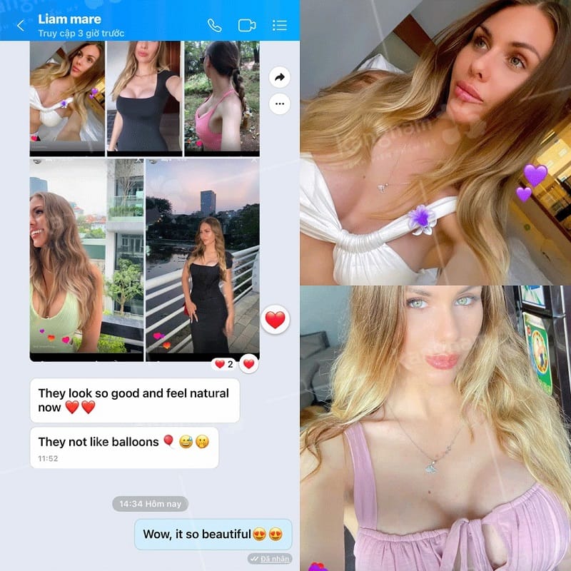 Thời gian phục hồi nhanh sau nâng ngực, giúp khách hàng có thể về nước ngay