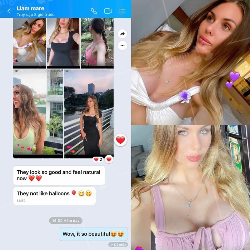 Khách hàng phản hồi sau khi nâng ngực tại Việt Nam