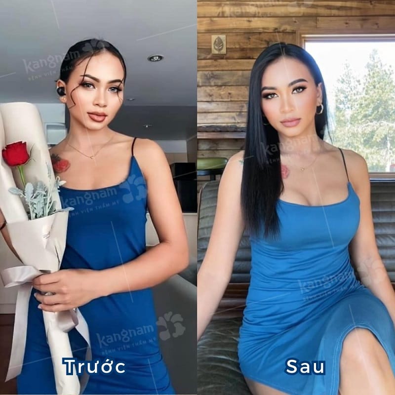 Nhiều khách hàng nước ngoài lựa chọn về Việt Nam nâng ngực