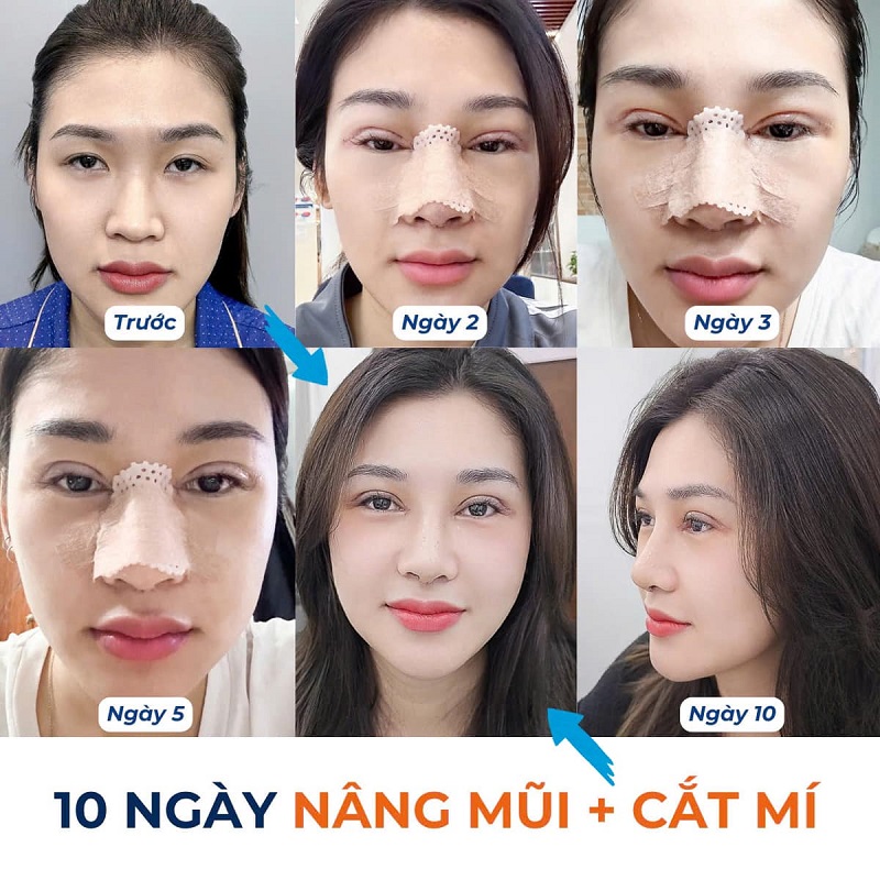 Thời gian phục hồi sau phẫu thuật thẩm mỹ diễn ra khá nhanh