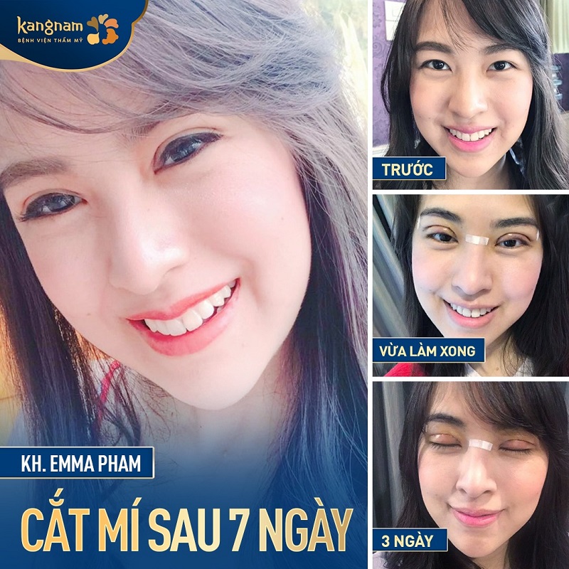 Khách hàng Việt Kiều cắt mí tại Kangnam có thời gian phục hồi nhanh