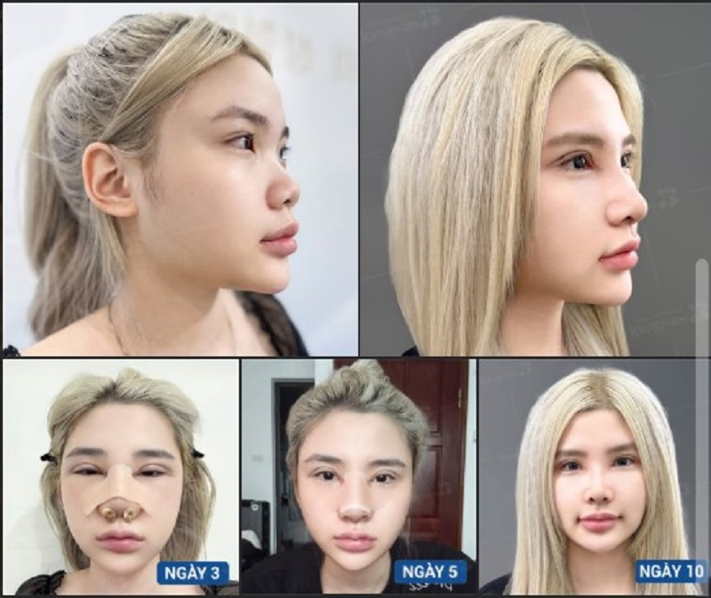 Dáng mũi nhanh chóng vào form, đẹp tự nhiên