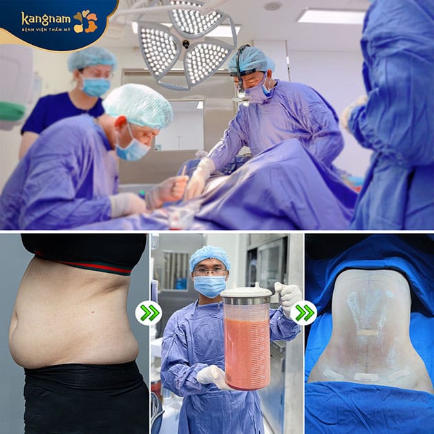 Hút mỡ an toàn khi thực hiện tại cơ sở uy tín