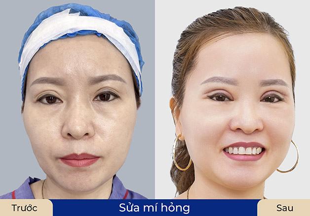 Revision eyelid surgery is more expensive than a standard procedure.