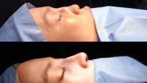 Revision Rhinoplasty & Cost for International Patients