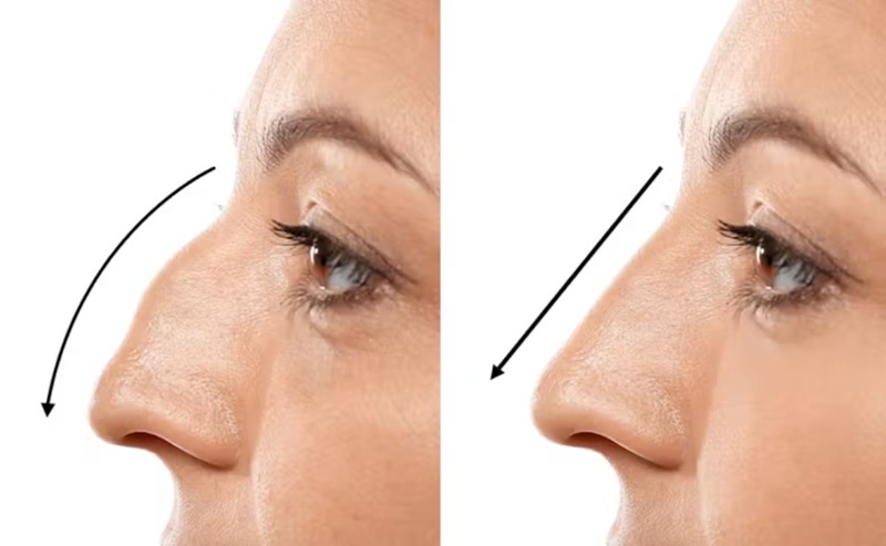 Nose augmentation is a minor cosmetic surgery procedure.