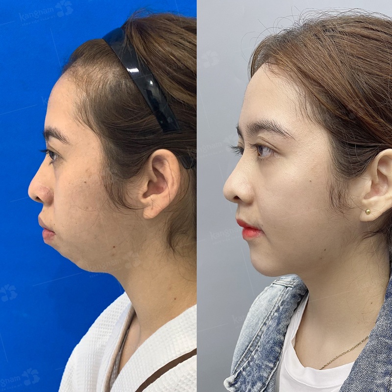 The nose has recovered to its correct shape and is soft.