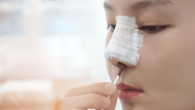Proper nasal hygiene and minimal touching of the nose after rhinoplasty surgery.