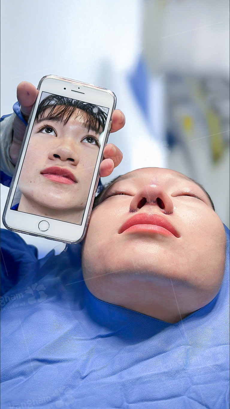 Open rhinoplasty helps to comprehensively reshape the nose.