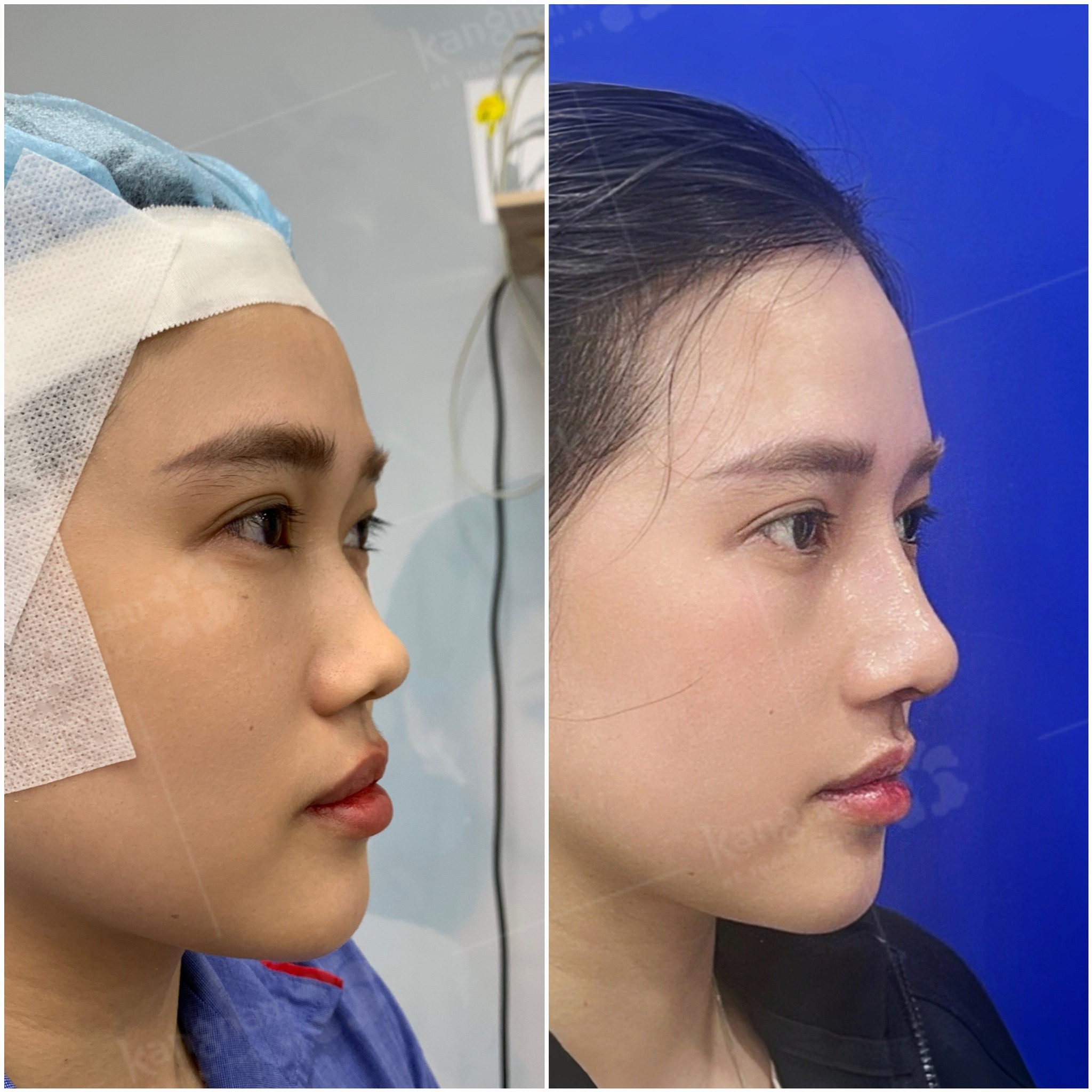 Nose augmentation corrects the problem of a wide, coarse nose.