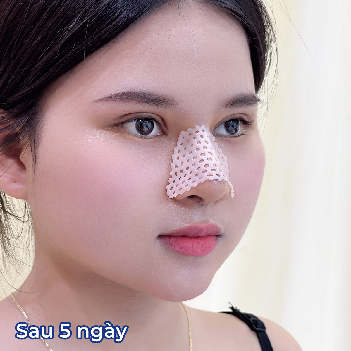Patients need to wear a splint immediately after rhinoplasty.